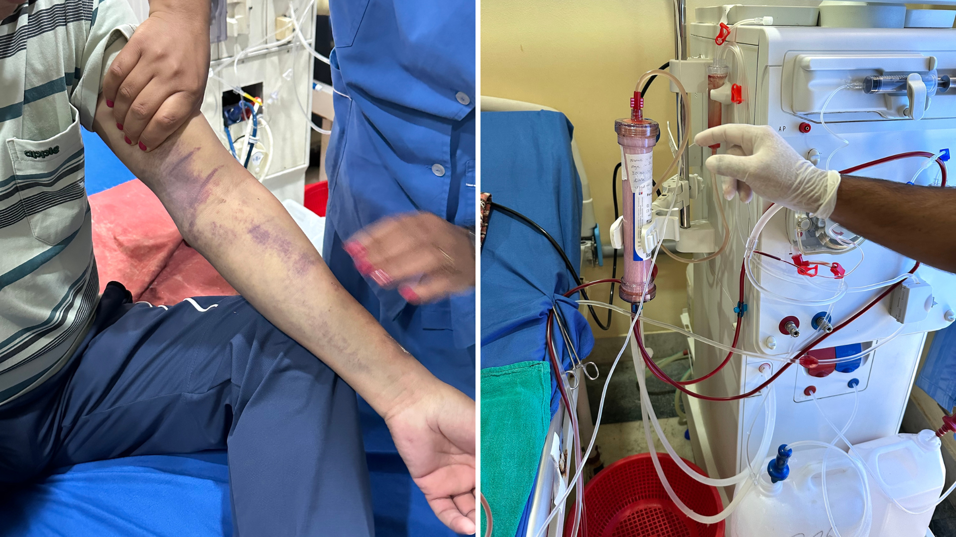 The image shows a bruised hand and a dialysis machine.